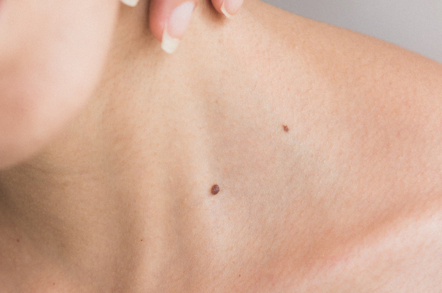 Fibroblast Plasma Pen Skin Tag Removal: Does it Work?